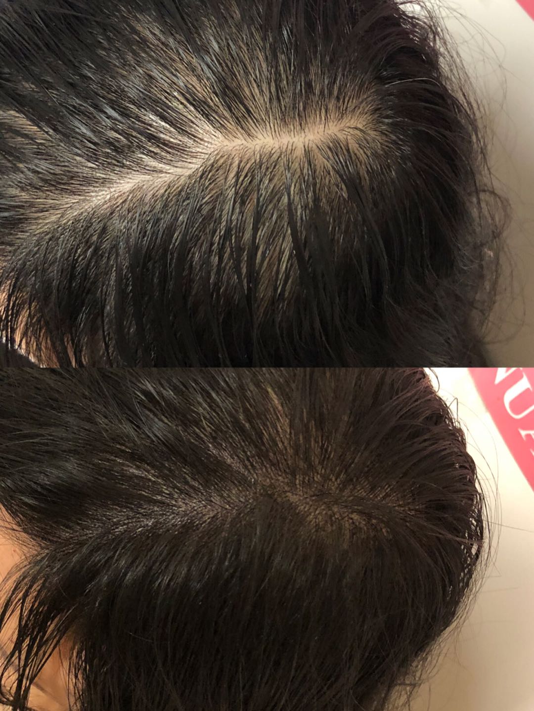 Hairline Microblading  Ai Beauty Clinic